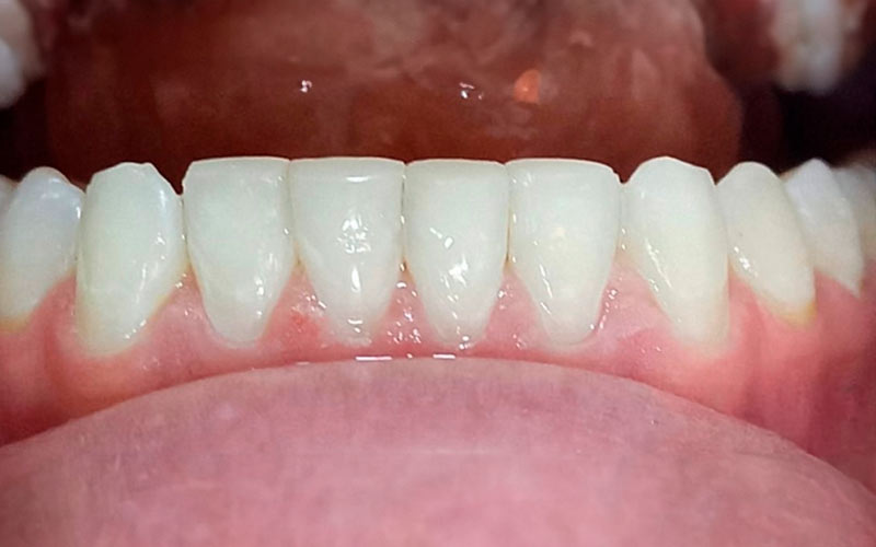 bordes incisales