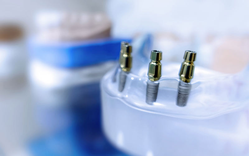 implantes dentales