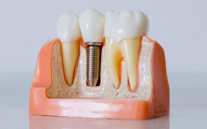 implantes dentales