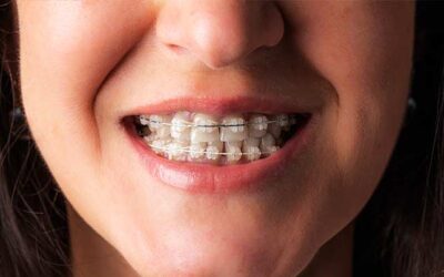 Ortodoncia: ¿Qué tipo debo elegir?
